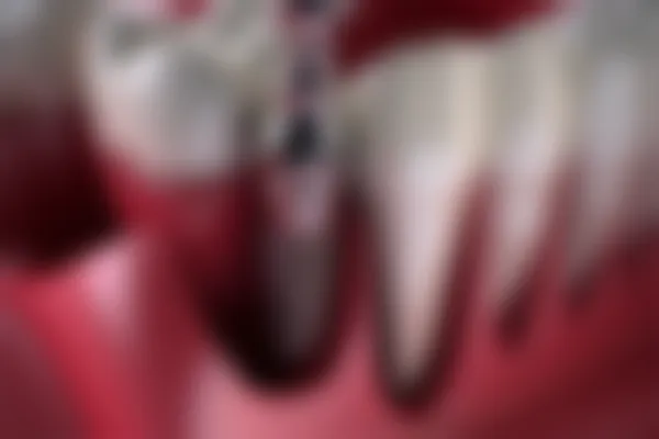 2026年杭州格莱美米兰格莱美口腔医院种植牙费用详解，了解真实价格与服务内容