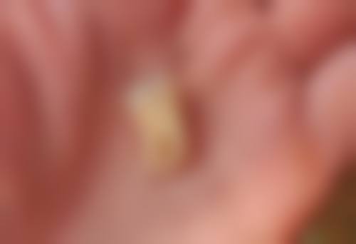 张淑婷医生技术优势