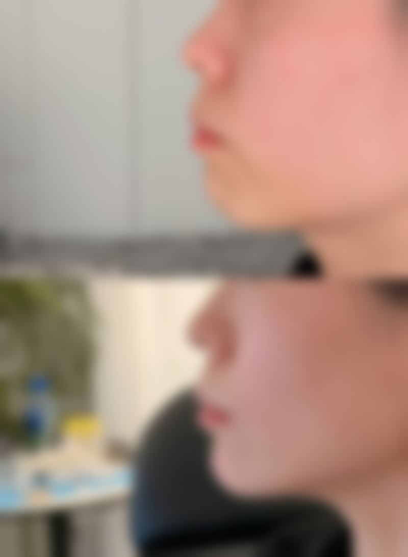 患者真实评价 | 汤卫华 广州新发现植发医院 口碑