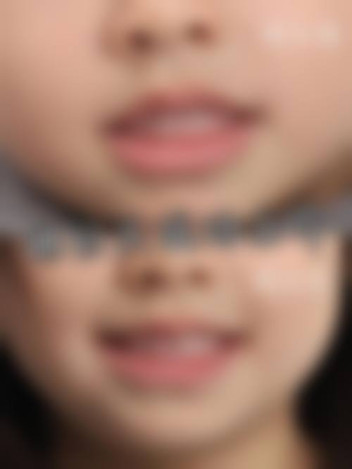 练小清医生擅长哪些矫正项目？自锁托槽与隐形矫治详解